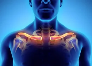 Thoracic outlet syndrome