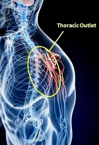 Thoracic Outlet Syndrome Treatment in London